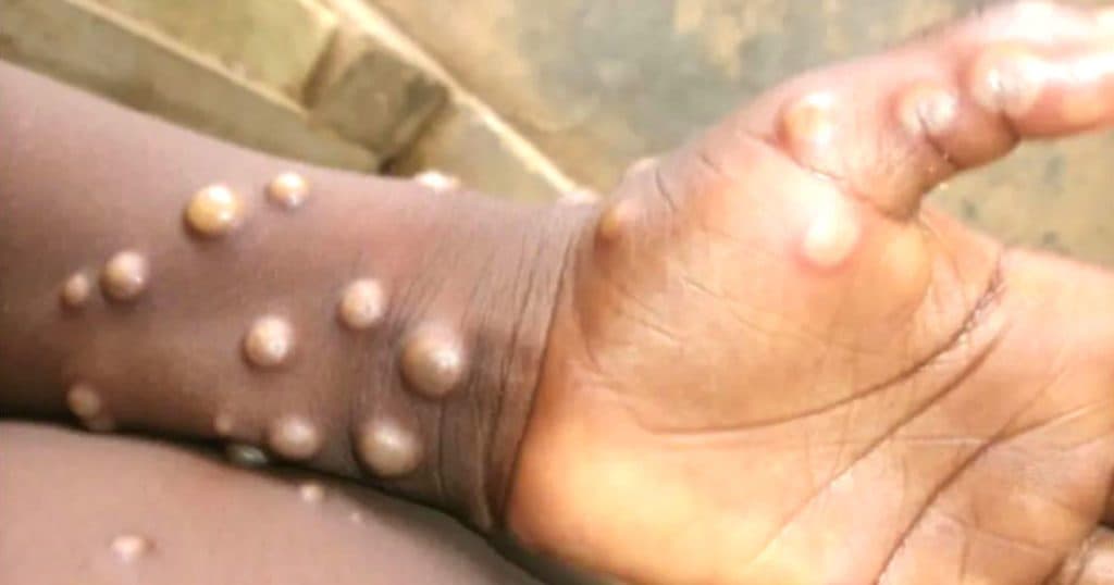 मङ्कीपक्स बढ्न थालेपछि निगरानी बढाउन डब्लुएचओको आह्वान